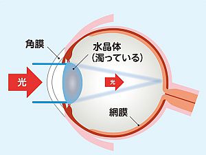 白内障の眼のイラスト