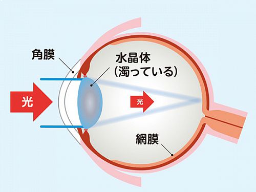 白内障の眼のイラスト